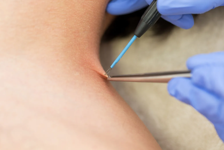 Pulled Out Plantar Wart Root